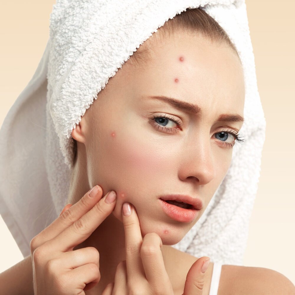 Nutrasain Anti Acne - Image 2